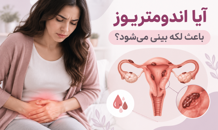 آیا اندومتریوز باعث لکه بینی می‌شود