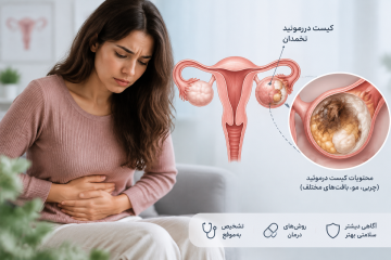 علت کیست درموئید تخمدان