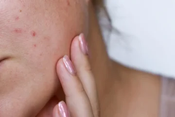 جوش زدن ناگهانی در تمام بدن